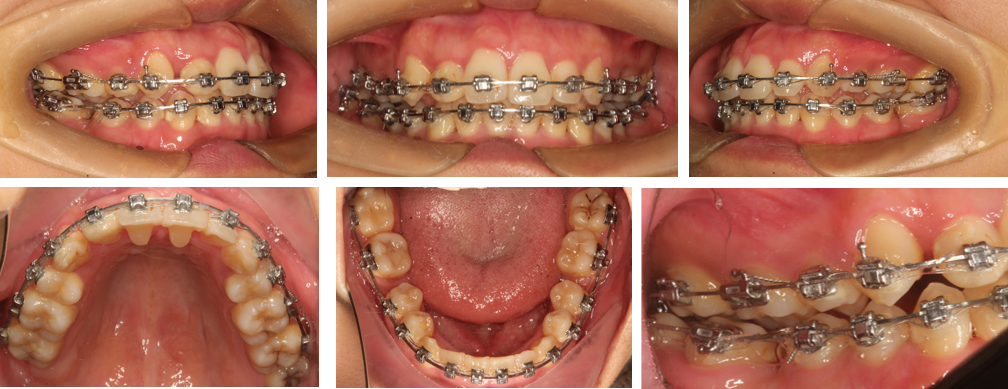 华文自锁托槽病例丨上下颌不对称拔牙矫治一例