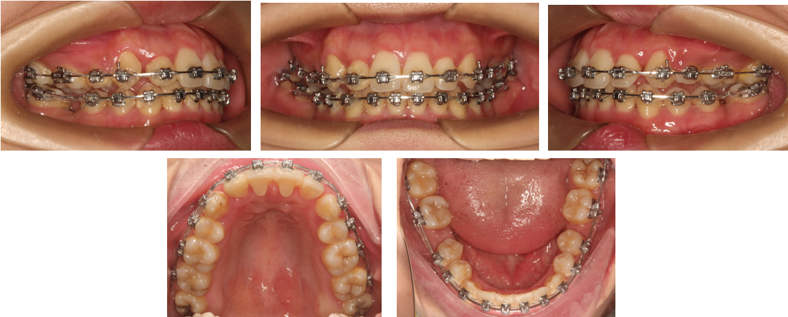 華文自鎖託槽病例丨上下頜不對稱拔牙矯治一例_託槽_牙槽_正畸材料